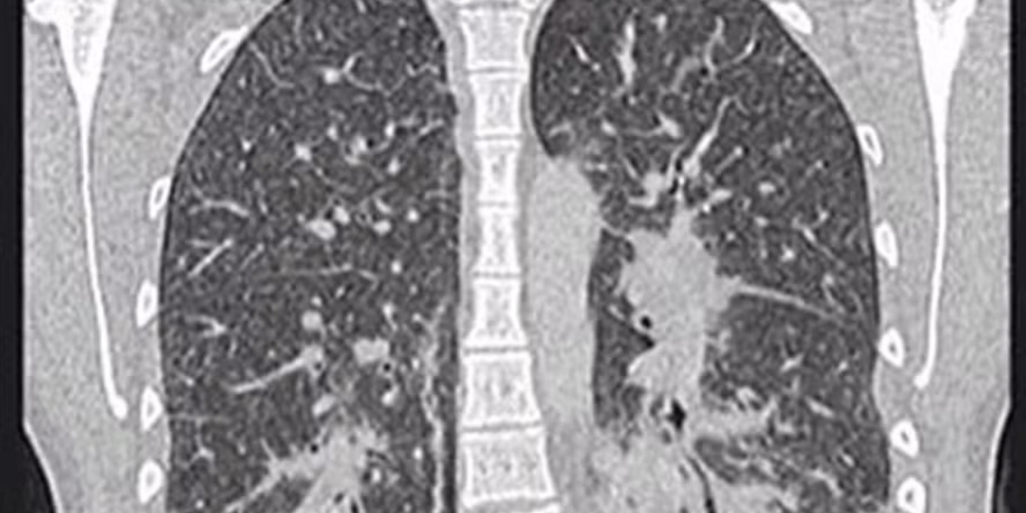 Pulmão de pipoca: entenda a doença respiratória causada por aromatizantes presentes em vapes e alimentos