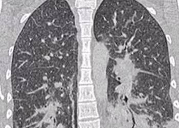 Pulmão de pipoca: entenda a doença respiratória causada por aromatizantes presentes em vapes e alimentos