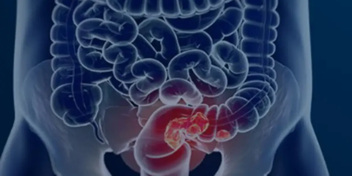 Vegetais crucíferos podem reduzir em até 20% o risco de câncer de intestino, aponta estudo