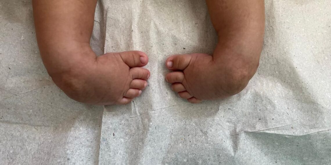 Tratamento de pé torto congênito transforma realidade de crianças em Aparecida de Goiânia