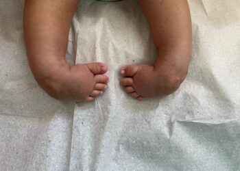 Tratamento de pé torto congênito transforma realidade de crianças em Aparecida de Goiânia