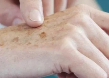 Inteligência artificial alcança 95% de precisão na detecção de melanoma