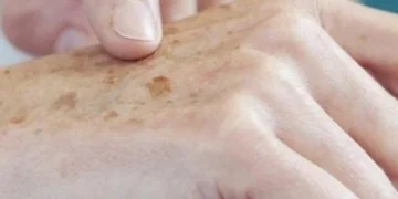 Inteligência artificial alcança 95% de precisão na detecção de melanoma