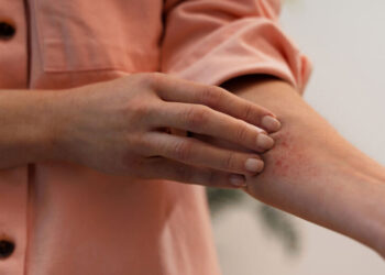 Alerta de verão: alergia ao sol atinge mais pessoas e exige cuidados