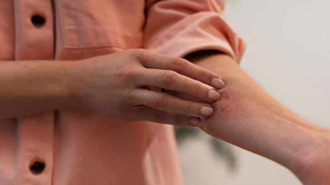 Alerta de verão: alergia ao sol atinge mais pessoas e exige cuidados