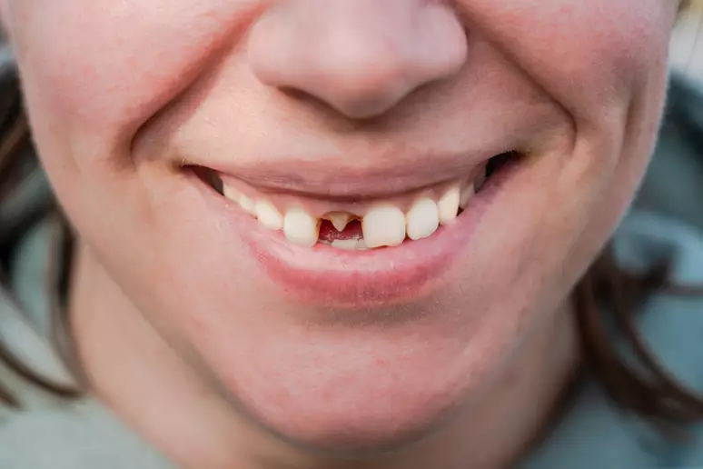 Japão avança no desenvolvimento de medicamento capaz de fazer nascer novos dentes