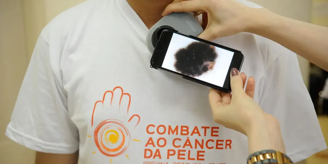 Casos de câncer de pele aumentam quase 17 vezes em uma década