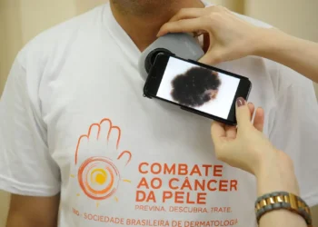 Casos de câncer de pele aumentam quase 17 vezes em uma década