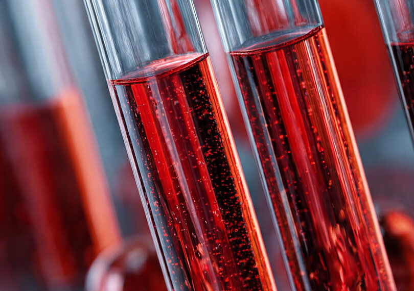 Exame de sangue pode detectar Parkinson com 20 anos de antecedência