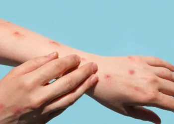 Mpox mantém vigilância ativa no Brasil e exige atenção aos primeiros sintomas