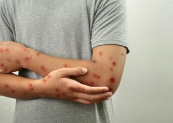 Alerta da mpox: Brasil confirma novos casos e reforça vigilância sobre grupos vulneráveis